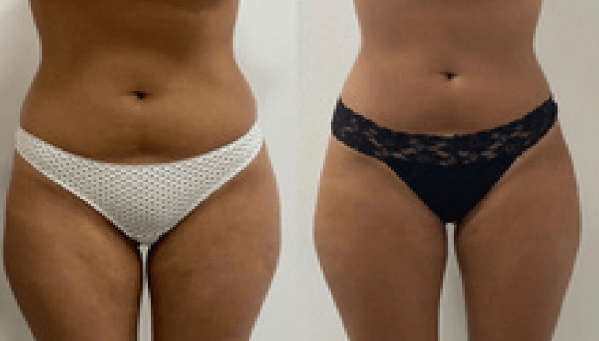 Dr Chong Slimmingy | Before After