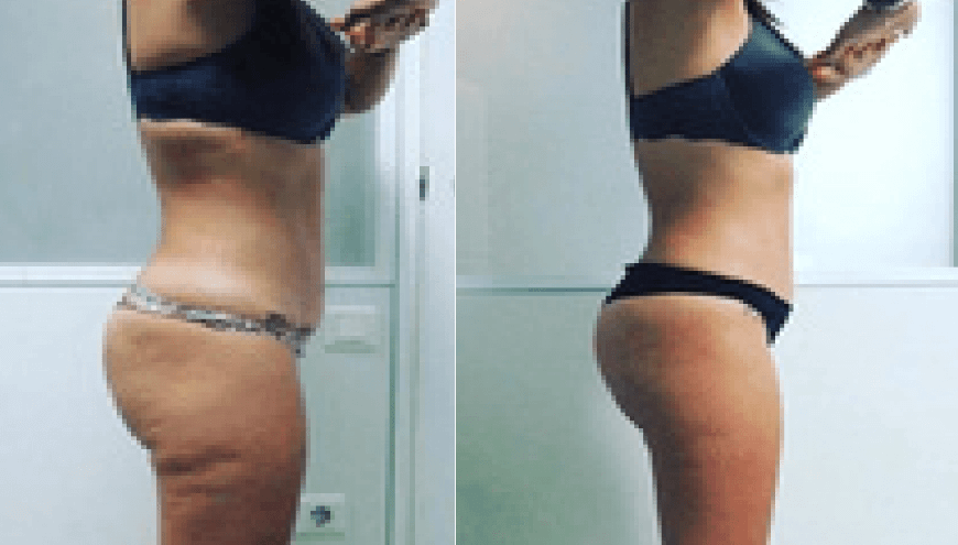 Dr Chong Slimming | Before After