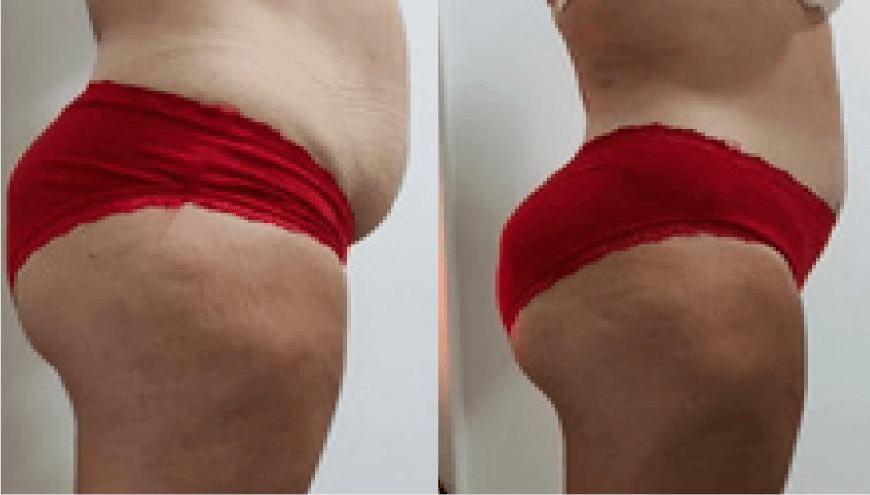 Dr Chong Slimming | Before After