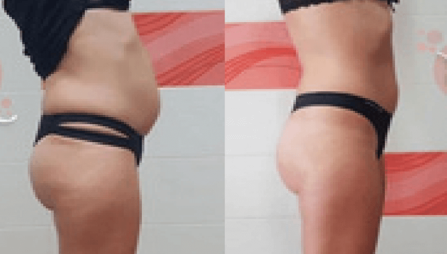 Dr Chong Slimming | Before After