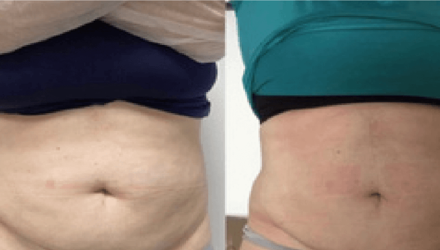 Dr Chong Slimming | Before After