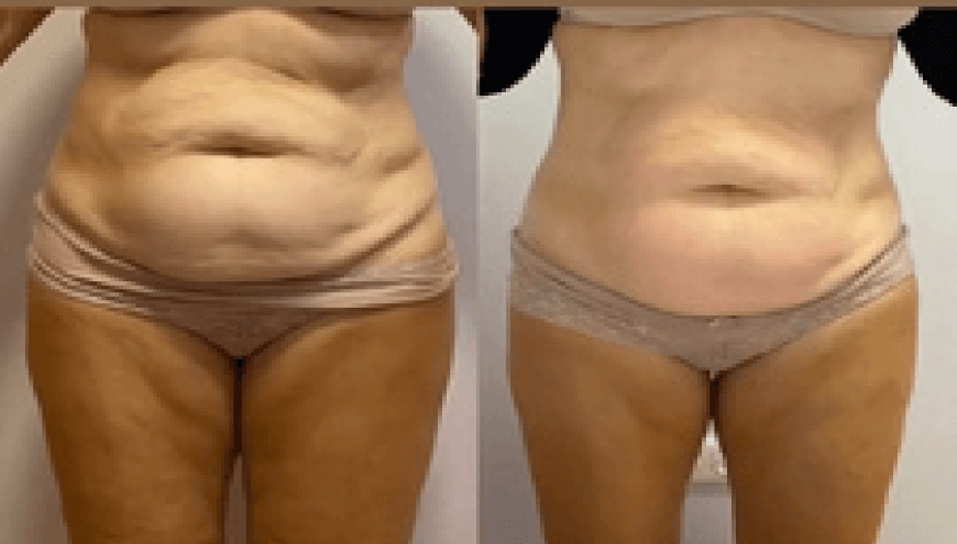 Dr Chong Slimming | Before After