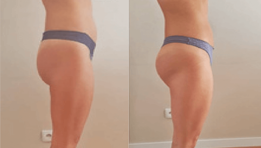 Dr Chong Slimming | Before After